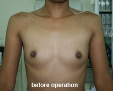 plastic-surgery-breast-augmentation