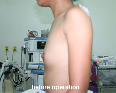 plastic-surgery-breast-augmentation