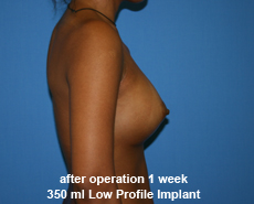 plastic-surgery-breast-augmentation