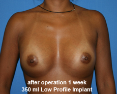 plastic-surgery-breast-augmentation