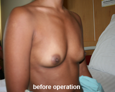 plastic-surgery-breast-augmentation