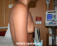 plastic-surgery-breast-augmentation