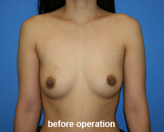 plastic-surgery-breast-augmentation