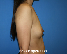 plastic-surgery-breast-augmentation