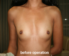 plastic-surgery-breast-augmentation