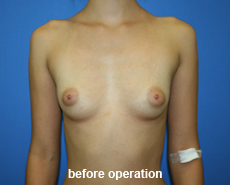 plastic-surgery-breast-augmentation