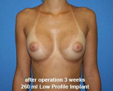 plastic-surgery-breast-augmentation