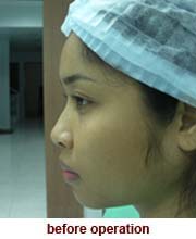 plastic_surgery_augmentation_rhinoplasty