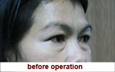 plastic-surgery-blepharoplasty