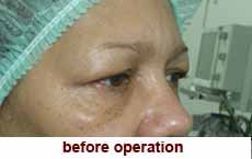 plastic-surgery-blepharoplasty