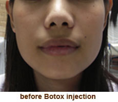 plastic_surgery_botox_injection_chin_angle_reduction