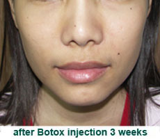 plastic_surgery_botox_injection_chin_angle_reduction