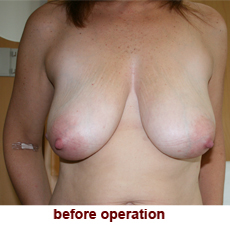 plastic-surgery-breast-lift
