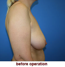 plastic-surgery-breast-lift-augmentation