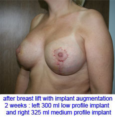 plastic-surgery-breast-lift-augmentation