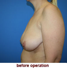 plastic-surgery-breast-lift-augmentation
