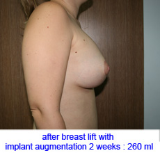 plastic-surgery-breast-lift-augmentation