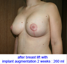 plastic-surgery-breast-lift-augmentation