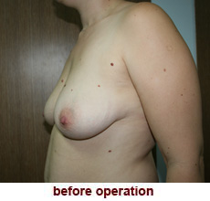 plastic-surgery-breast-lift-augmentation