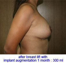 plastic-surgery-breast-lift-augmentation