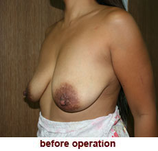 plastic-surgery-breast-lift-augmentation