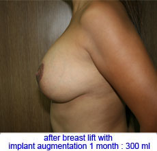 plastic-surgery-breast-lift-augmentation