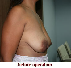 plastic-surgery-breast-lift-augmentation