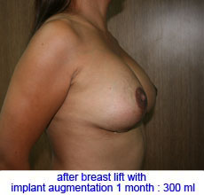 plastic-surgery-breast-lift-augmentation