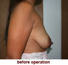 plastic-surgery-breast-lift-augmentation