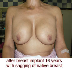 plastic-surgery-breast-lift-augmentation