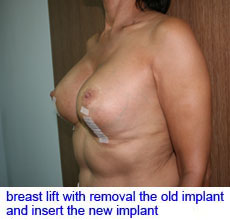 plastic-surgery-breast-lift-augmentation
