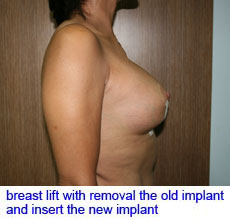 plastic-surgery-breast-lift-augmentation