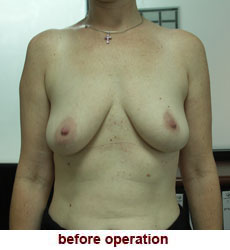 plastic-surgery-breast-lift-augmentation