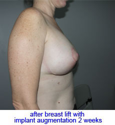 plastic-surgery-breast-lift-augmentation