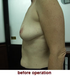 plastic-surgery-breast-lift-augmentation
