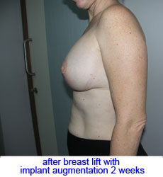 plastic-surgery-breast-lift-augmentation