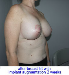 plastic-surgery-breast-lift-augmentation
