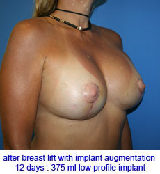 plastic-surgery-breast-lift-augmentation