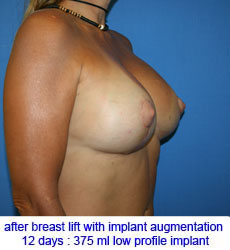 plastic-surgery-breast-lift-augmentation