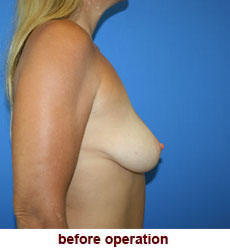 plastic-surgery-breast-lift-augmentation