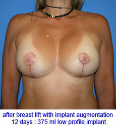 plastic-surgery-breast-lift-augmentation