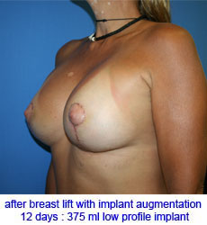 plastic-surgery-breast-lift-augmentation