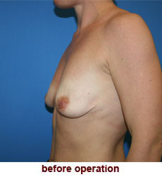 plastic-surgery-breast-lift-augmentation