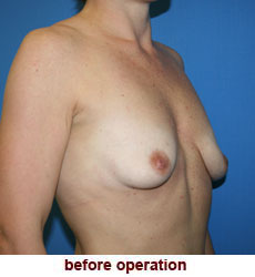 plastic-surgery-breast-lift-augmentation