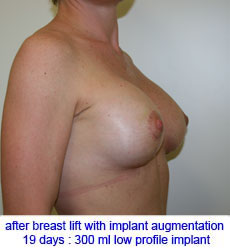 plastic-surgery-breast-lift-augmentation