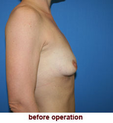 plastic-surgery-breast-lift-augmentation
