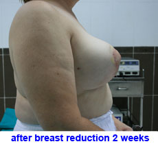 plastic-surgery-breast-reduction