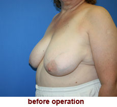 plastic-surgery-breast-reduction