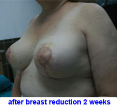 plastic-surgery-breast-reduction