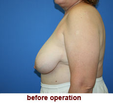 plastic-surgery-breast-reduction